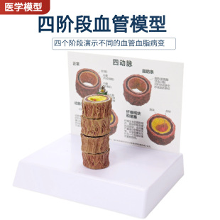 四阶段病理血管人体支脉硬化粥样心血管动脉模型硬化血脂形成模型