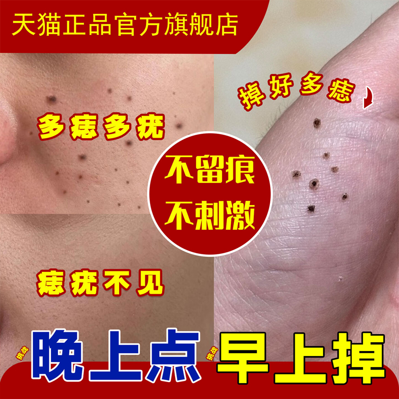 点痣膏正品祛斑点痣药水无痕不留疤修复液克疣去痔官方旗舰店3yw