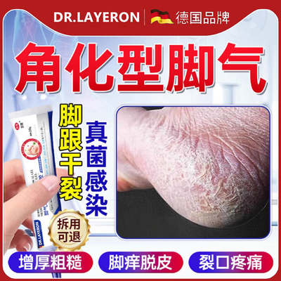去角化型脚气脚后跟干裂开裂脱皮专特用杀菌真菌感染止根效药痒bt