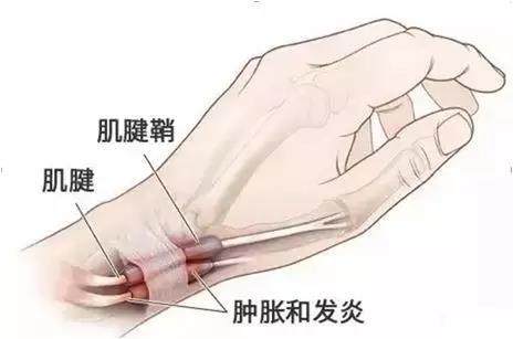 妈妈手鼠标手腱鞘扭伤护腕男女兼用大拇指矫正保护套