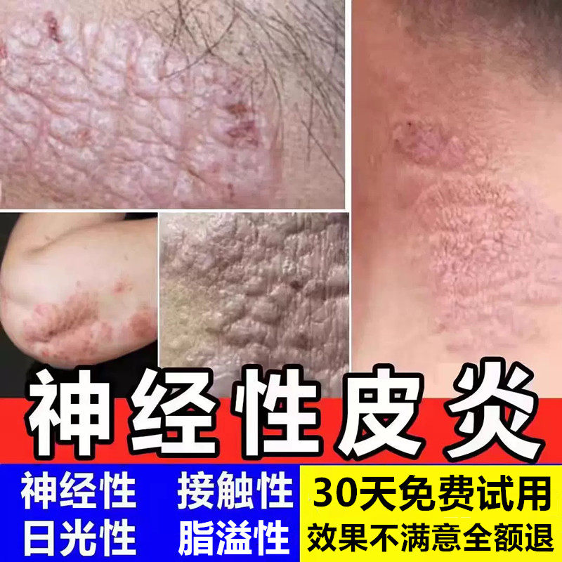治神经性皮炎外用膏顽固无激素根湿皮肤疹瘙痒脂溢除止痒膏祛去疗