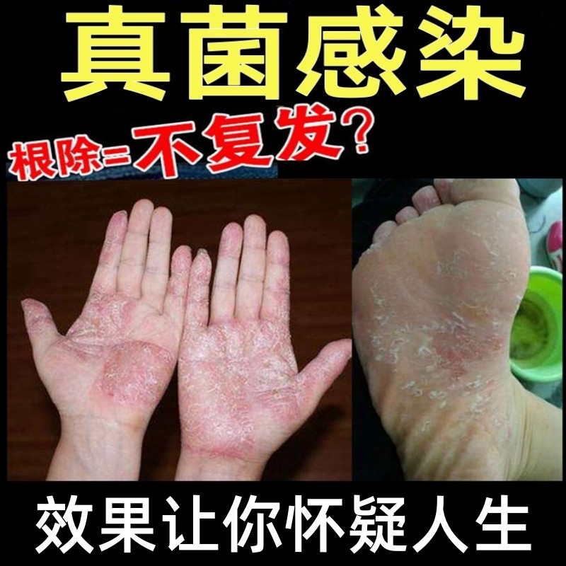 治脚上真菌感染脚底手癣膏皮肤病真菌感染银屑病痒头皮癣专用药膏