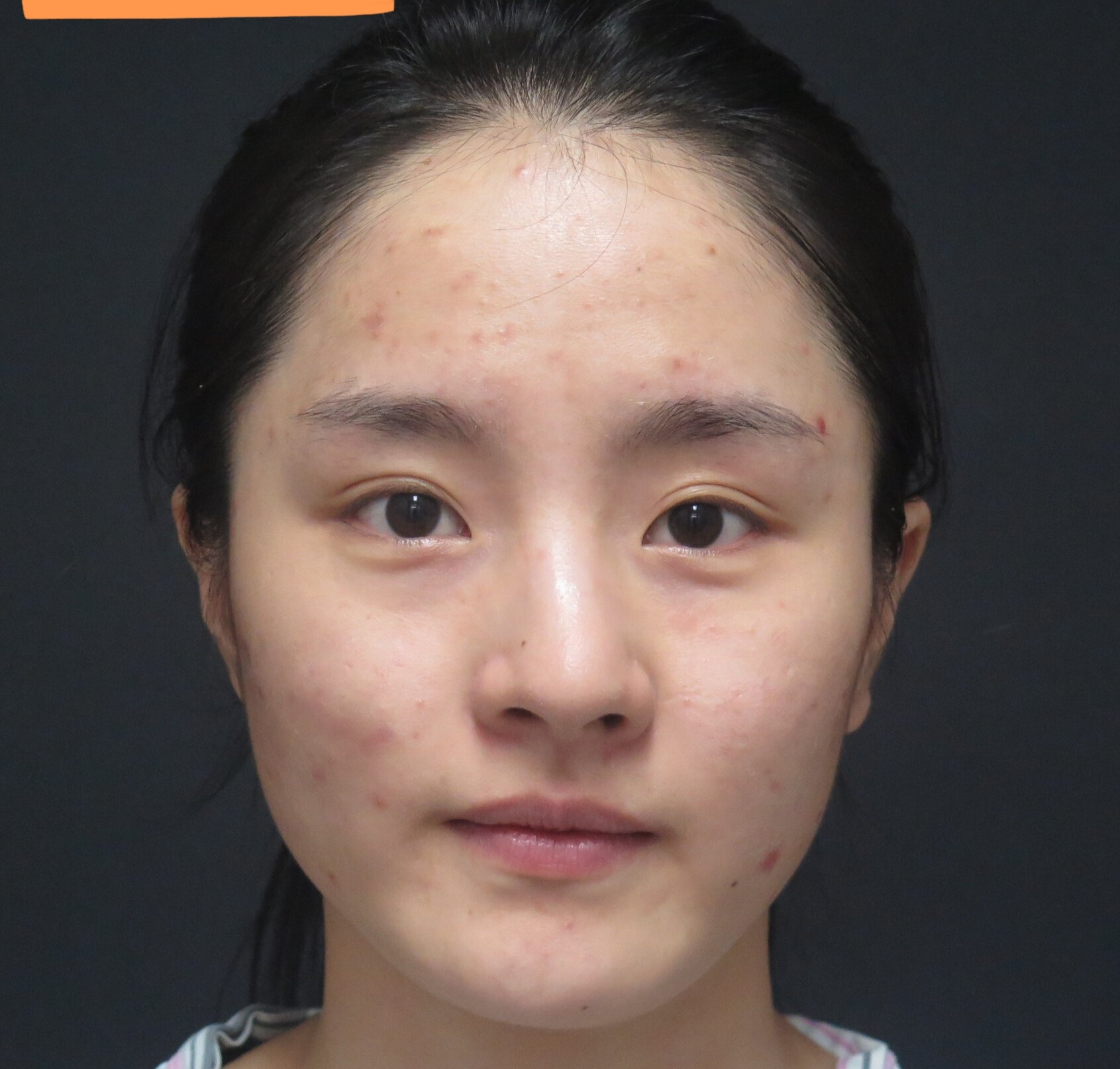 草本歪鼻矫正精华 改善修复歪鼻子复位美鼻神器鼻部变漂亮了