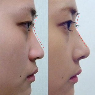 草本挺鼻精华 改善塌陷肥大精致立体鼻部隆鼻美鼻精油加强版