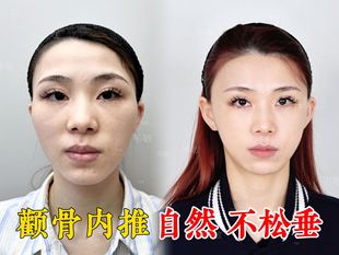 草本颧骨内推修复精华 内收改善脸骨突出精油加强版