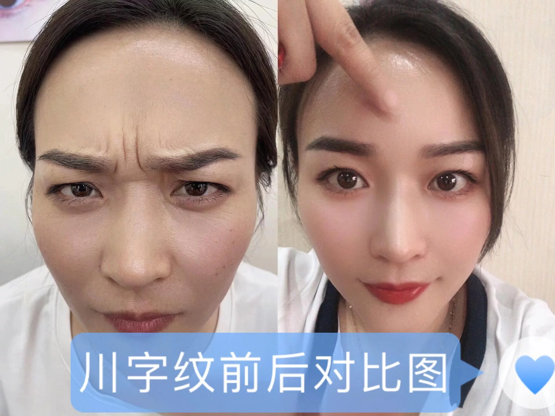 去皱纹抬头纹川字纹去除消除神器法令纹抗皱抗衰老提拉紧致女男士