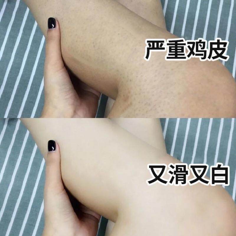 鸡皮肤疙瘩毛囊角化症去除神器 全身手臂腿改善胳膊上长疙瘩