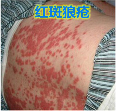 治疗盘状系统性红斑狼疮结节性的药膏