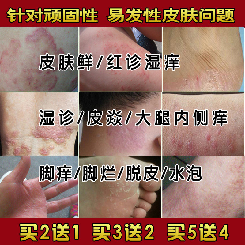 金蝉毒鲜王抑菌乳膏屁股痒大腿内侧痒手脚痒脱皮水泡