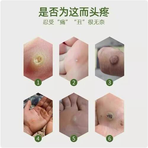 跖尤专用膏除拓尤鸡贴眼康去猴子肉粒疙瘩治瘊子修脚刀买一送一