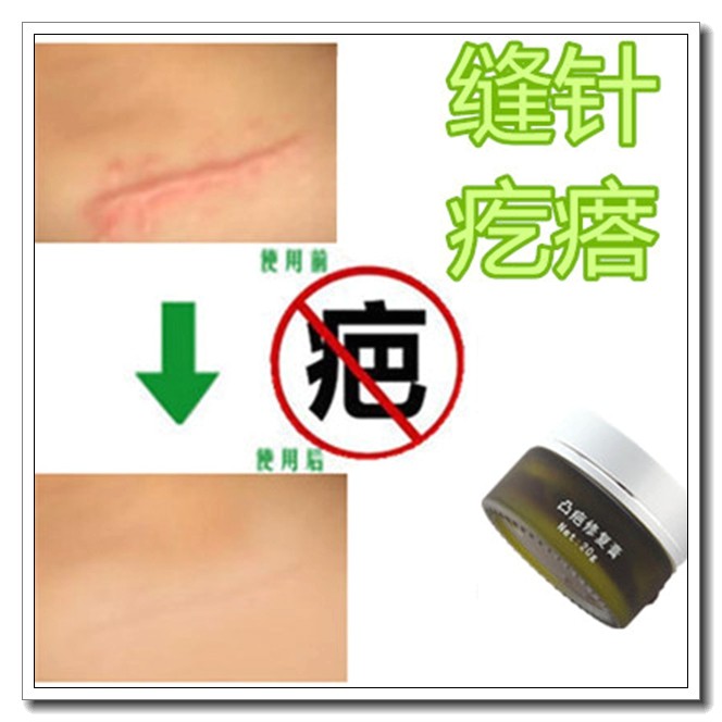 去除摔伤疤痕药膏产品修复舒疤宁硅酮凝胶消祛手术伤口愈合贴正品,美容护肤/美体/精油,复方精油,淘宝优惠券,粉丝福利购,淘宝优惠卷