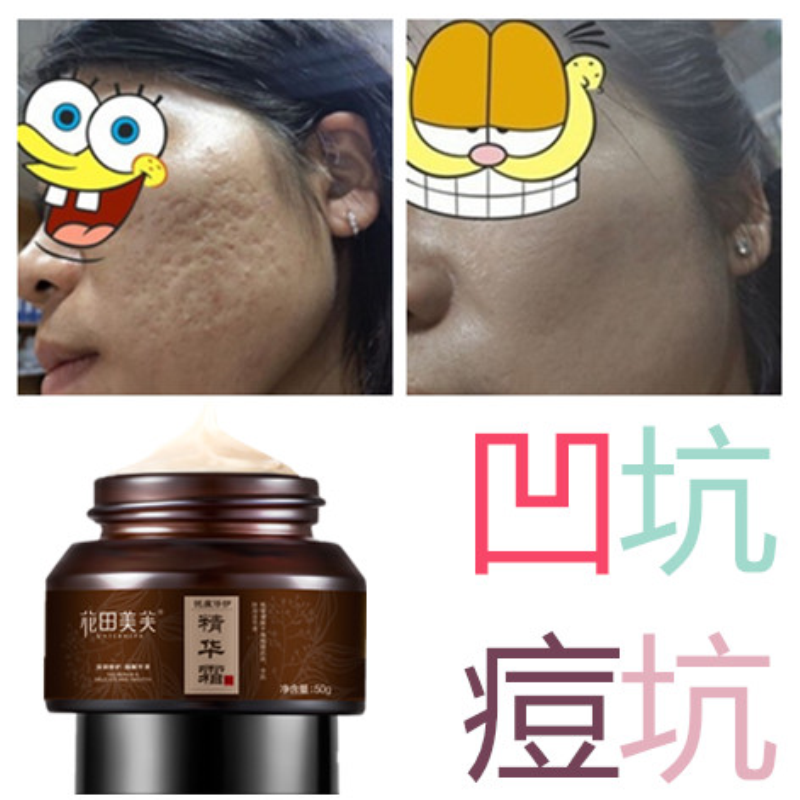 祛除凹坑抚平填充凹疤再生长膏精华产品去儿童痘坑淡化痘印修护液