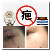 软化凸疙瘩祛除增生性手术剖宫产伤疤痕印灵纹身去沉着色素药乳膏