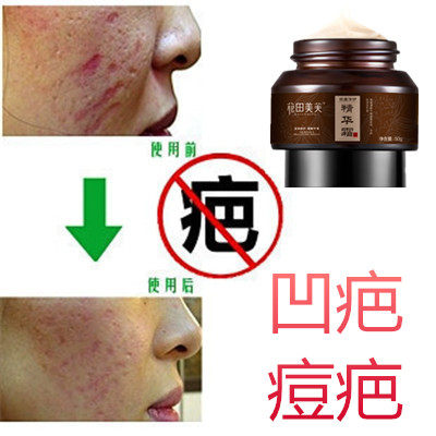 草本祛除凹洞痘坑快速再生长膏去男女士学生痘印淡化痘疤痕霜产品,洗护清洁剂/卫生巾/纸/香薰,其它,淘宝优惠券,粉丝福利购,淘宝优惠卷