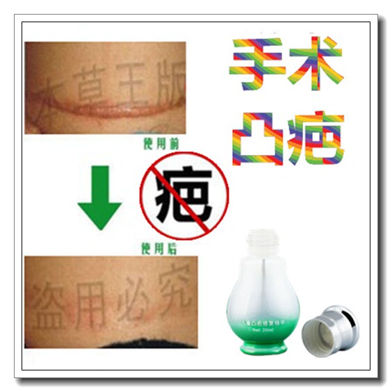 去除剖腹产后凹凸起伤口刀疤痕药膏淡化儿童黑色素沉淀红印修复贴