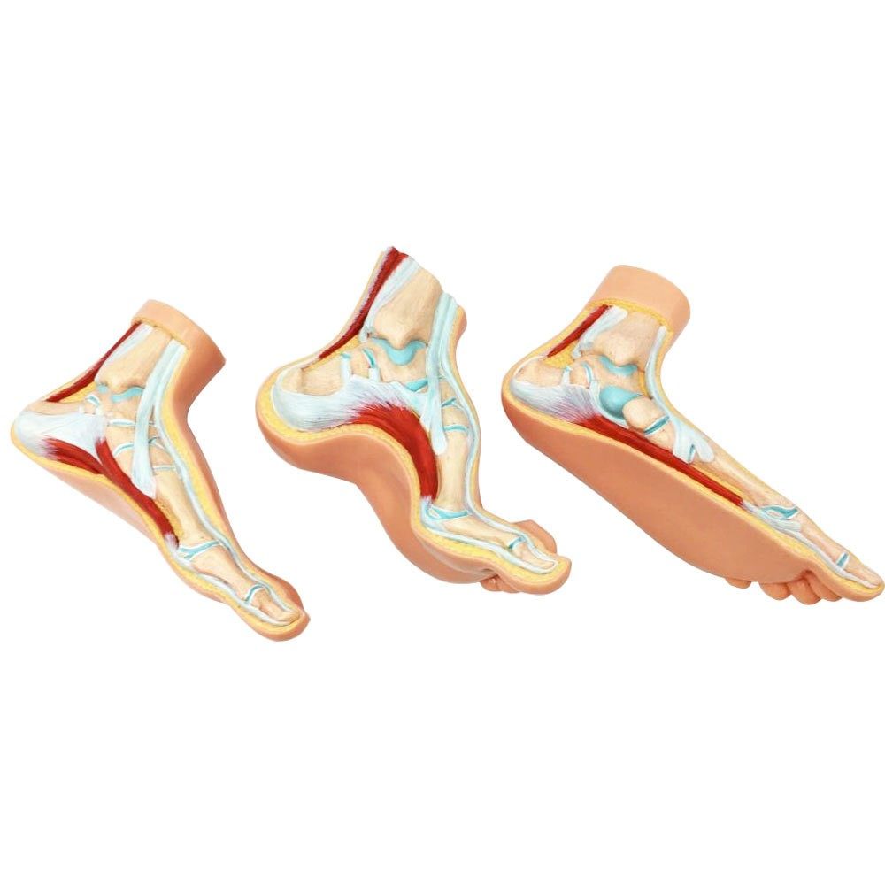 正常扁平足弓形足高弓足模型脚足弓模型康复矫正演示展示教具