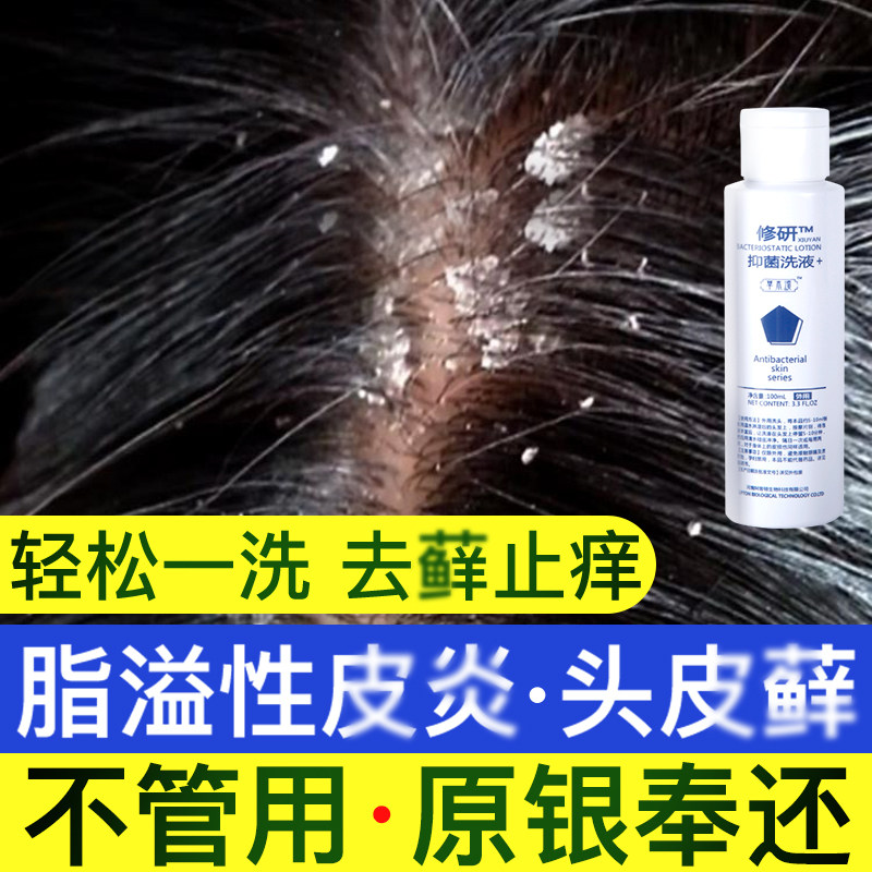 脂溢性皮炎头皮藓牛皮癣银屑病