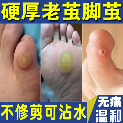 去老茧脚茧脚垫关节茧去鸡眼神器