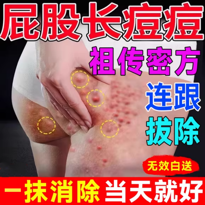【医师推荐】屁股长痘火疖拔毒膏