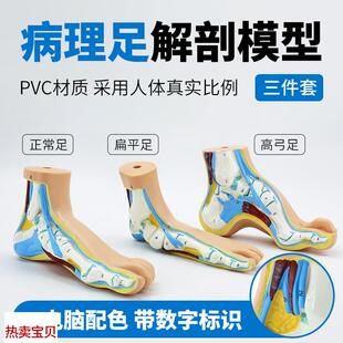 足部病理模型人体足部肌肉解剖模型 正常足 扁平足h 弓型足 模型