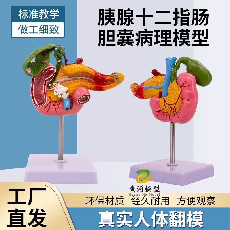 人体胰腺十二指肠胆囊病理模型 胆结石外科消系统a肝胆科医学模