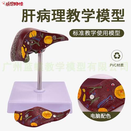 肝脏病理模型 脂y肪模型 肝胆模型 病变肝 仿真人体肝脏解剖模