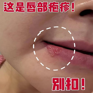 藤石制药嘴唇疱疹嘴巴上火起泡烂嘴角特单纯病毒效搭专用膏药贴YU