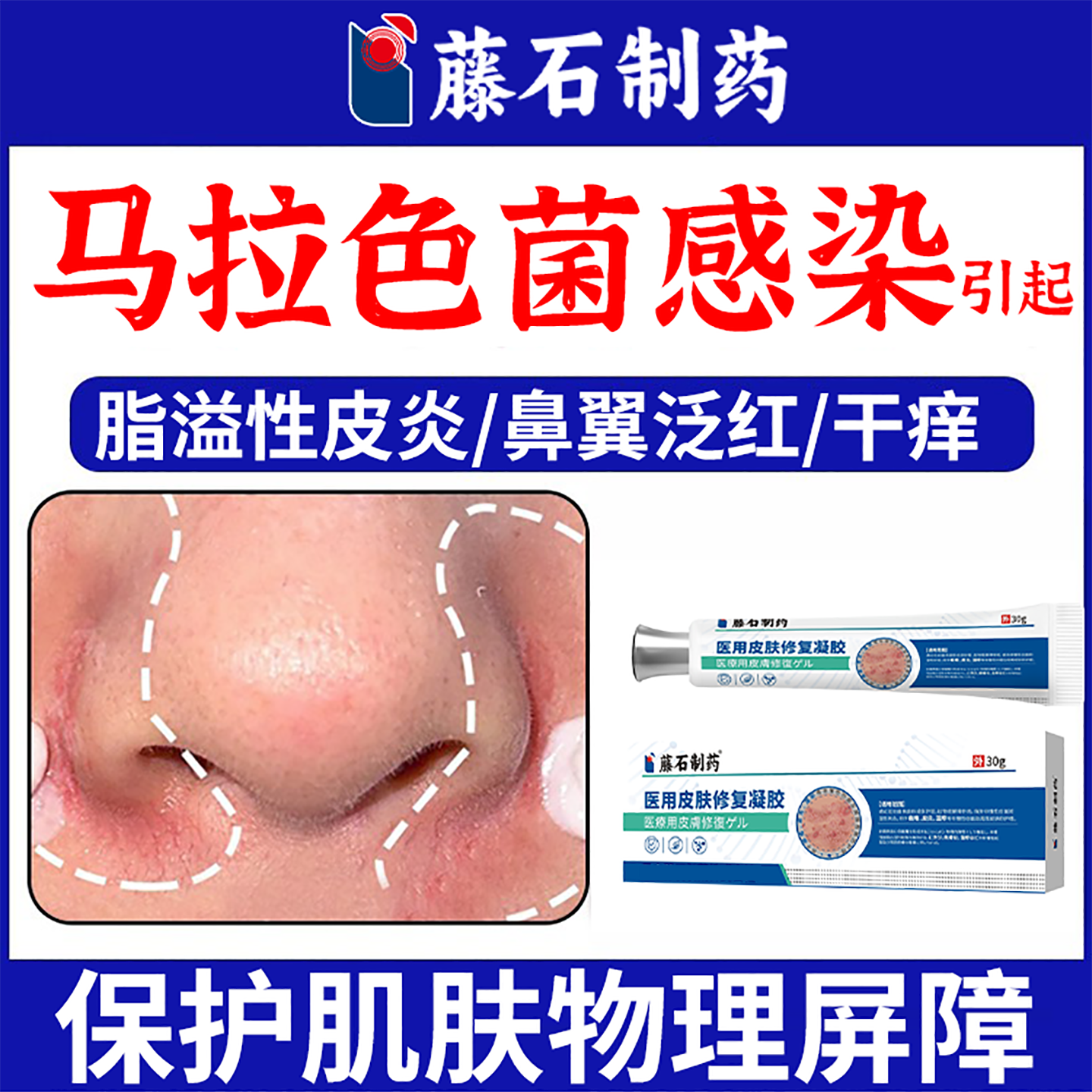 马拉色菌脂溢性皮炎面部护肤品鼻翼子两侧泛红脱皮干燥软膏ON