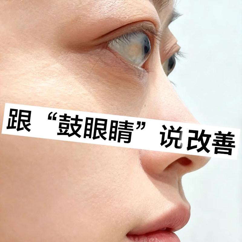 甲亢眼突眼贴眼睛眼球突凸出水肿胀矫正调理可搭眼药水中膏药贴YU