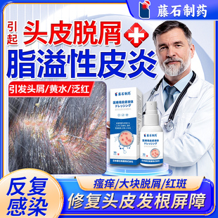 头皮脂溢性皮炎头部喷剂真菌感染头癣毛囊炎可搭二硫化硒洗发水ON