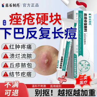 藤石制药下巴反复长痘痤疮膏红肿硬块痘痘调理淋巴痘脓包型闭口YU