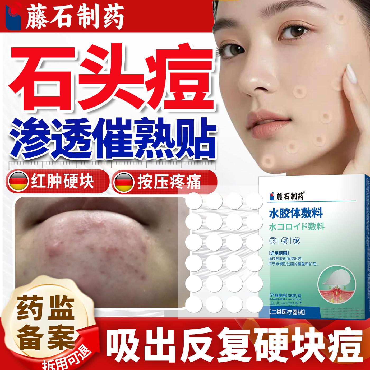 下巴反复长痘祛石头痘红肿硬块医用痘痘贴催熟修复消炎痘印吸脓ZY