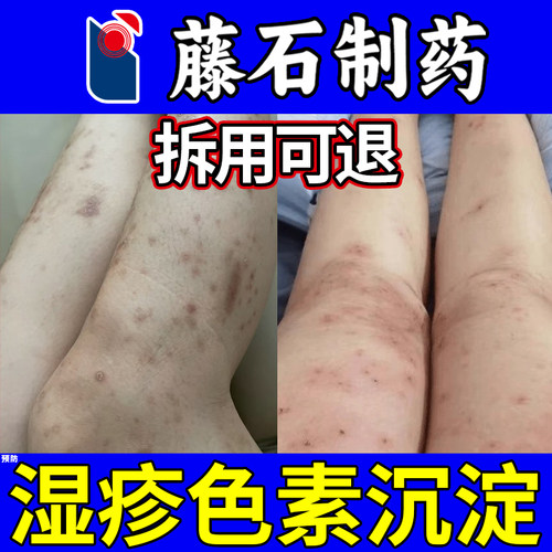 【预防湿疹黑色素沉淀】藤石制药