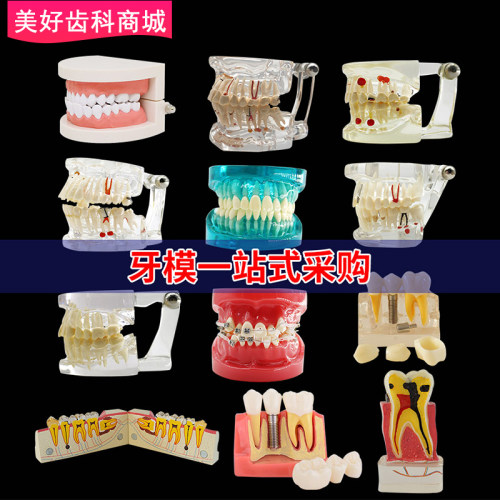 牙科教学模型口腔全口牙齿病理修复体牙模型标准种植模具医患沟通 - 封面
