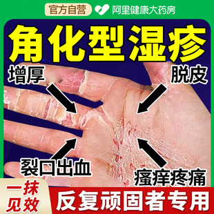 日本角化型湿疹手部手癣脱皮干裂真菌感染止痒角质化去膏根喷雾剂