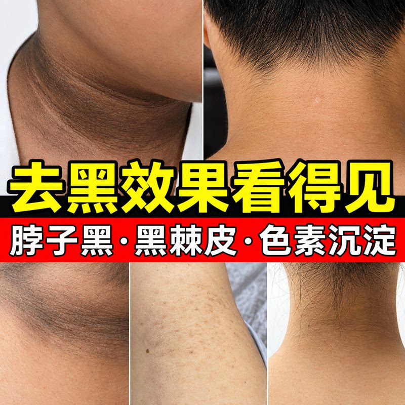 脖子黑棘皮症黑去除黑色脖子素去沉淀黑病药膏肥胖脖颈洗不干净