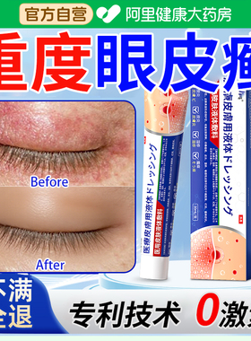 眼皮癣眼睛周围眼角痒干燥起皮掉屑红肿过敏发痒神经性皮炎神器药