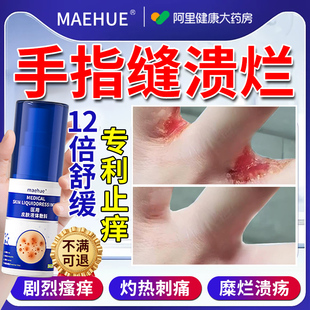 手指缝溃烂止痒脱皮水泡手气糜烂瘙痒手癣膏真菌感染烂手丫间药膏