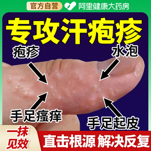 汗皰疹濕疹汗?fàn)畎捳钴浉嗨幐嗳楦嗍稚险婢腥臼职W皮膚瘙癢