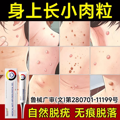 feconad扁平丝状专用无忧神器 脖子小肉粒球 无痛清除自然脱落