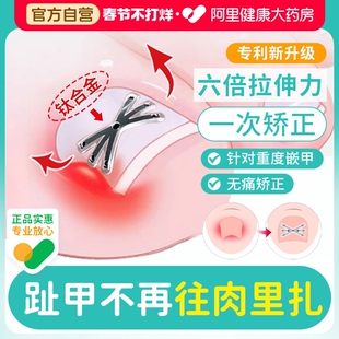 赤坂甲沟嵌甲炎矫正器正甲贴指甲内嵌纠正贴脚趾指甲往肉里长专用