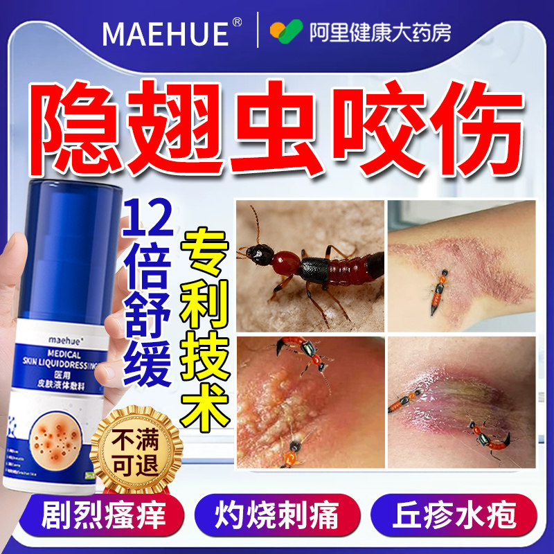 隐翅虫咬伤叮咬瘙痒快止痒消肿过敏蚊虫毒虫祛疤药膏湿疹皮肤效炎
