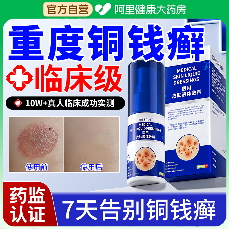 【临床医研】铜钱癣不反复