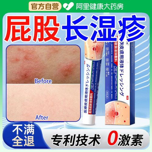 久坐板疮男起热毒疙瘩股藓专用真菌感染臀部