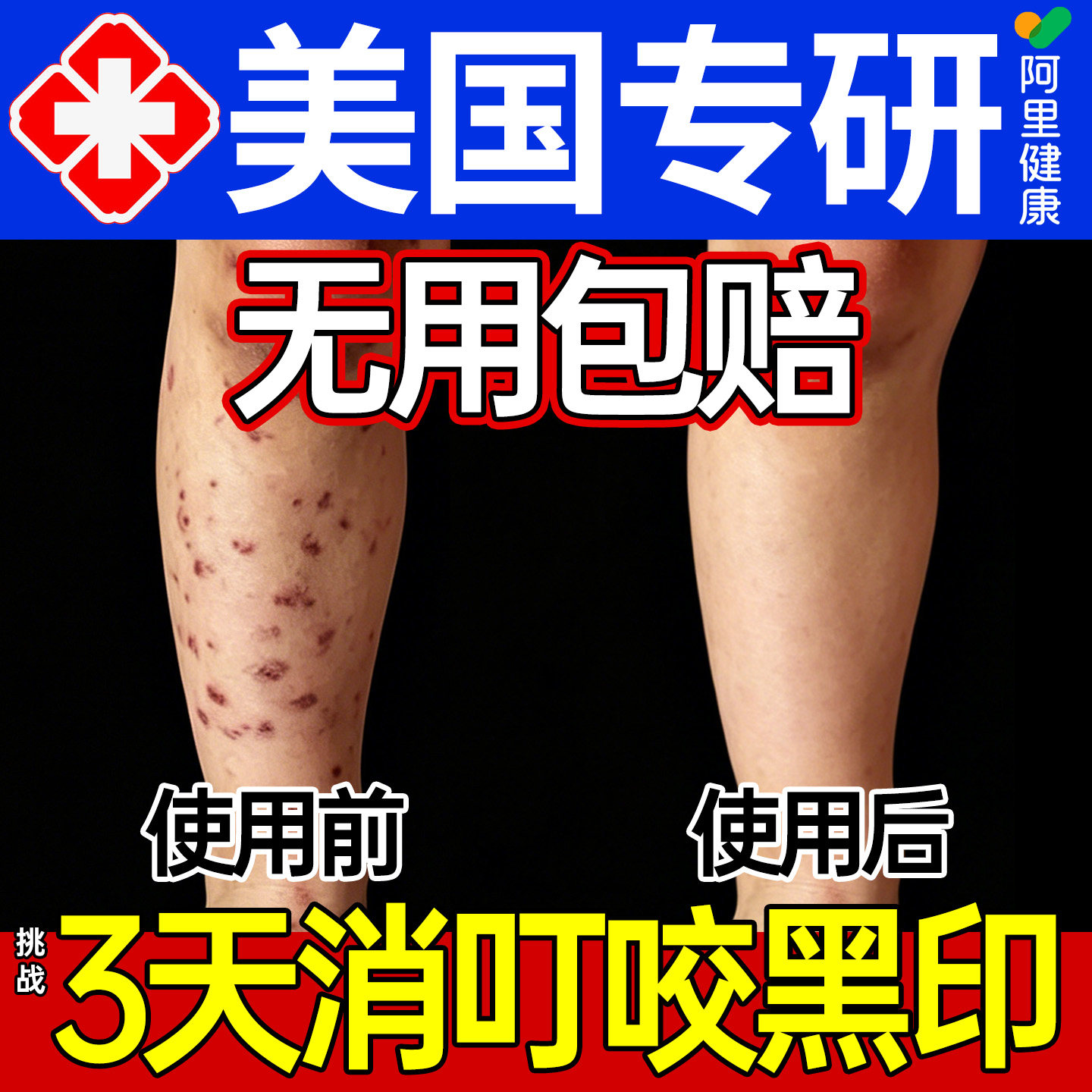 蚊虫叮咬祛疤膏去黑印腿上蚊子咬的疤黑色素沉淀儿童成人淡化修复