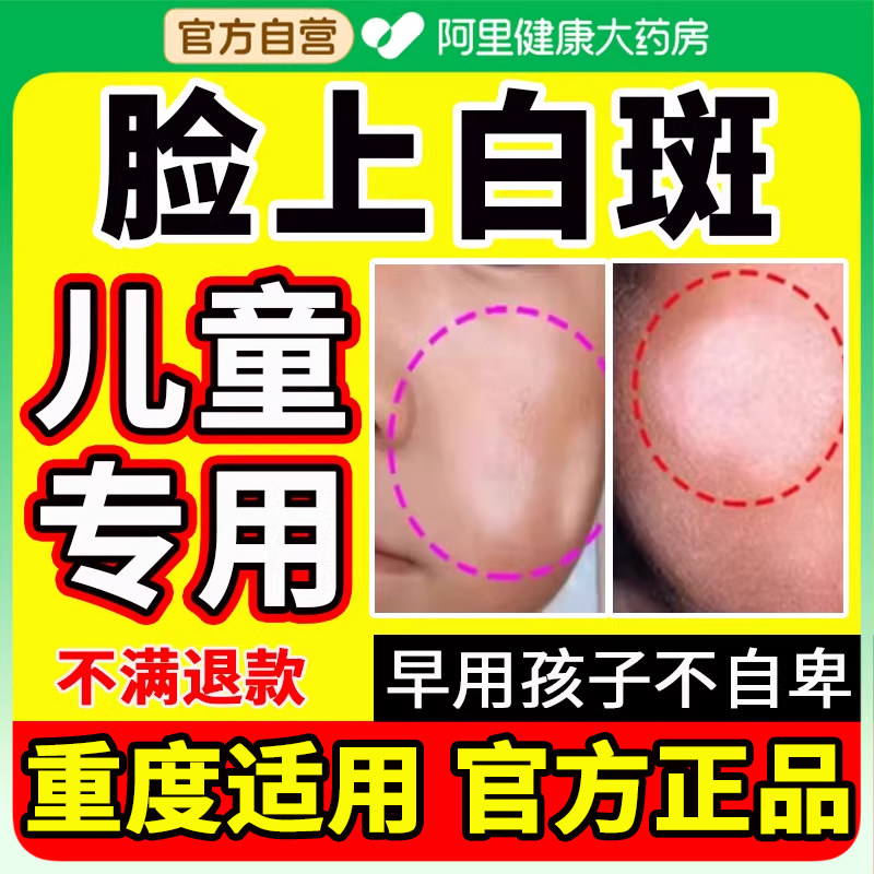 白色糠疹儿童脸上长白斑长癣玫瑰花汗斑脸部皮肤花斑癣药膏湿疹