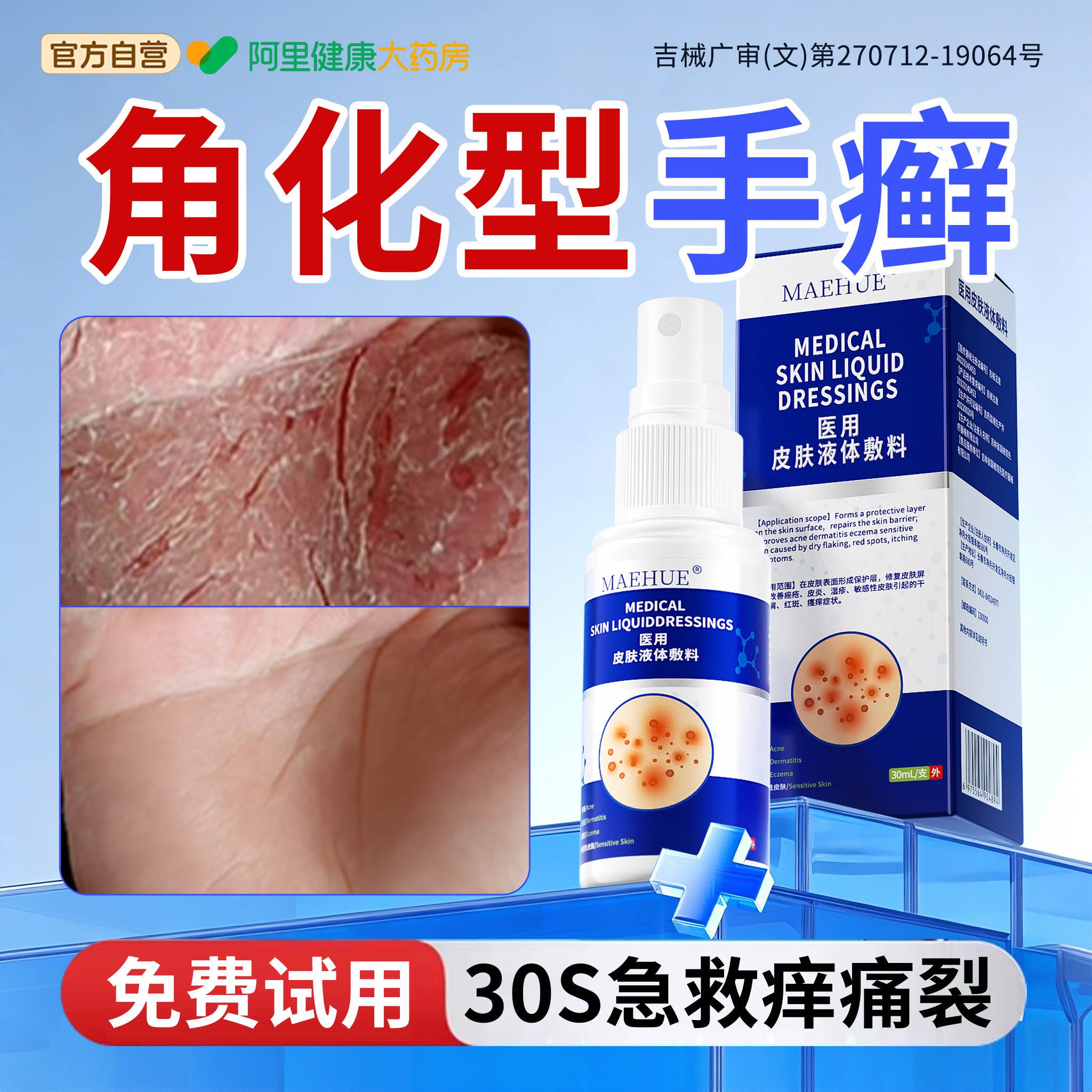 手指角化型湿疹手癣脱皮干裂痒真菌感染手足癣鹅掌风手脚增厚乳膏