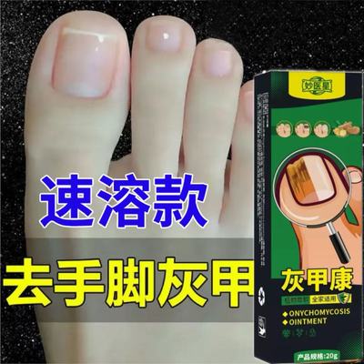 灰指甲脱甲膏专用抑菌液甲沟炎灰趾指甲快速脱甲精油脚指甲软化剂