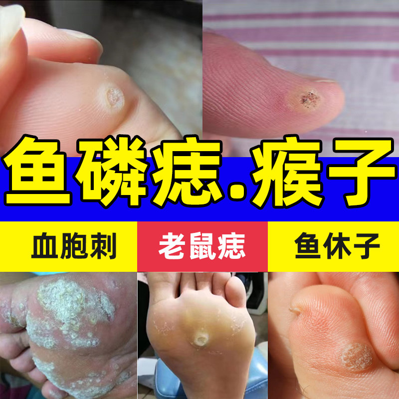 老鼠痣去鱼鳞痣贴手上长瘊子脚上硬疙瘩鱼休子血胞刺去除膏血泡刺