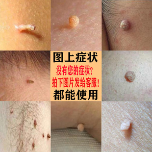 丝状疣去除颈部小肉瘤肉猴子特傚治肉瘊子药膏脖子腋下肉粒老鼠痣